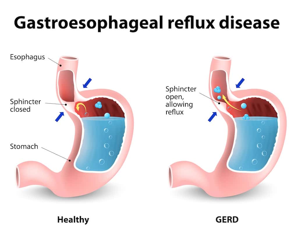 Lifestyle Changes To Manage GERD.